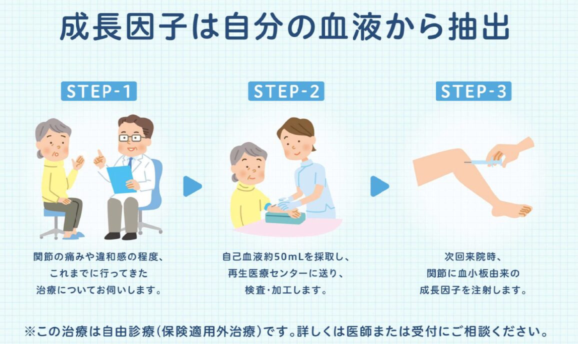 「成長因子は自分の血液から抽出」というタイトルで、治療の全3ステップを説明する図解です。STEP-1: 医師との診察。関節の痛みや違和感、過去の治療歴を確認します。STEP-2: 採血。自分の血液を約50mL採取し、再生医療センターで検査・加工を行います。STEP-3: 注射。次回来院時に、加工された血小板由来の成長因子を関節に注射します。この治療が自由診療(保険適用外)です。詳しくは医師または受付にご相談ください。